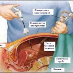 лечение кисты яичника лапораскопия