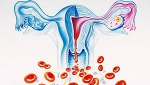Обильные менструации со сгустками
